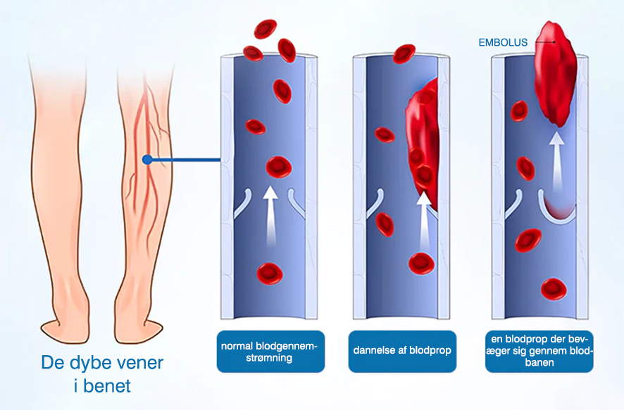 🔥Ourlyard® VeinGuard Urtespray – ✅ Klinisk dokumenteret til at fjerne åreknuder på kun 7 dage!