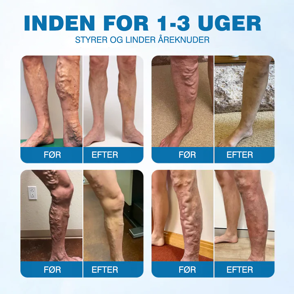 🔥Ourlyard® VeinGuard Urtespray – ✅ Klinisk dokumenteret til at fjerne åreknuder på kun 7 dage!